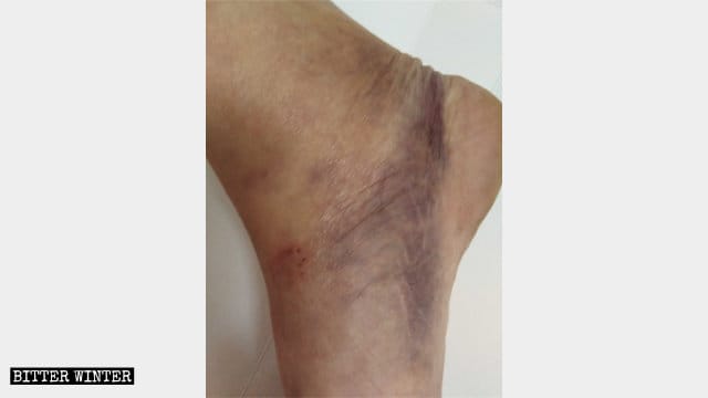 魏礼輝さんは暴行を受けて足に怪我をした。